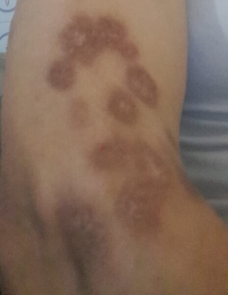 Long-distance partner has an unexplained rash and I am worried