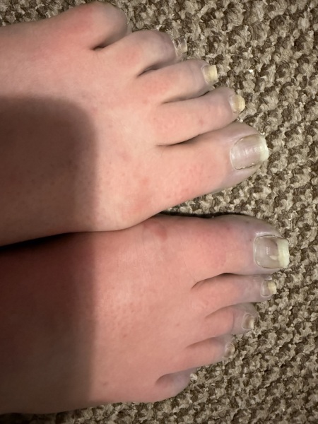 Weird rash on my toes & other symptoms anyone else had this?