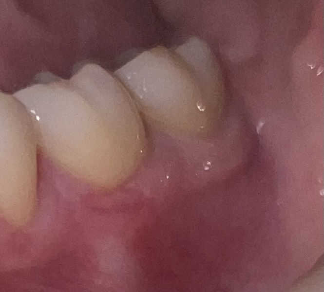 Persistent mouth ulcer near wisdom tooth for six weeks, GP or dentist?