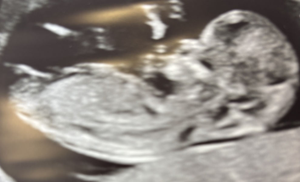 Any guesses on baby's sex from a 12 week scan?