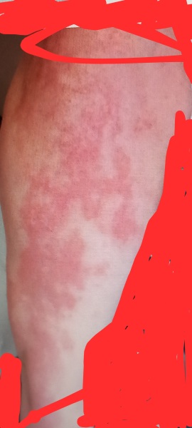 Rash driving me utterly mad - any ideas what it might be as I await referral to dermatology??