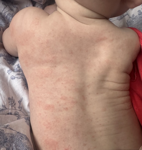 Going mad now, what could be causing this awful rash on 6 month old. With photo
