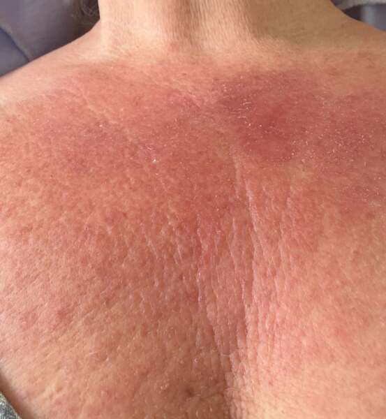 Prickly heat rash on chest not improving, any suggestions?