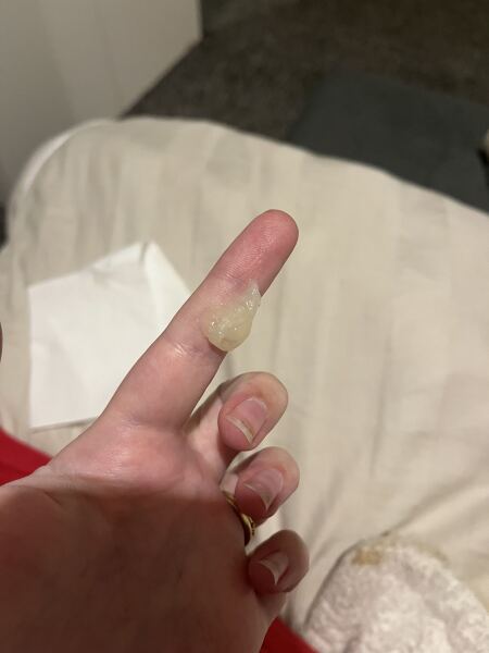 22 weeks pregnant and +++ protein in urine as well as pain