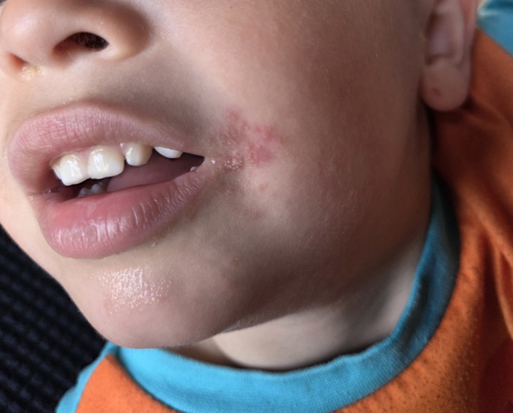 Persistent rash at the corner of my child’s mouth, any ideas?