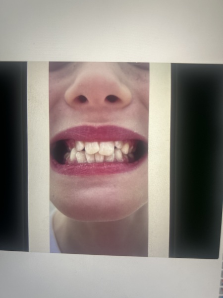 Dentist… Molar incisor hypomineralisation