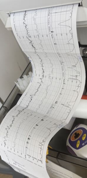 Can anybody help interpret my TOCO CTG!?