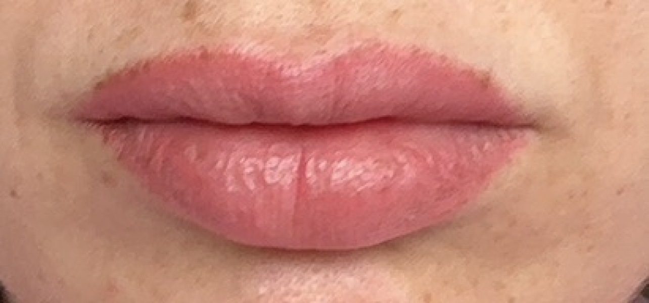 To ask if you had terrible embarrassing lip filler swelling