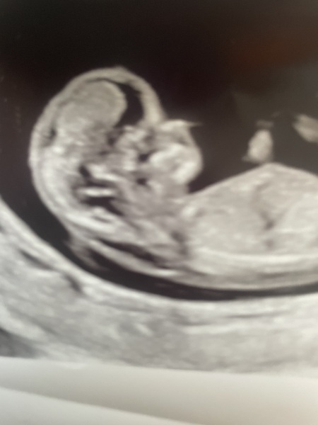 Concerns about back on baby’s neck on scan