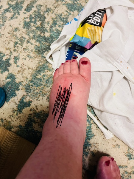 Help with swelling - top of left foot