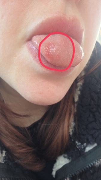 Odd patch on my tongue but no pain, any ideas?