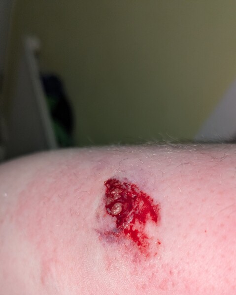 AIBU to ask if this arm wound needs attention? Contains a bloody pic of said wound