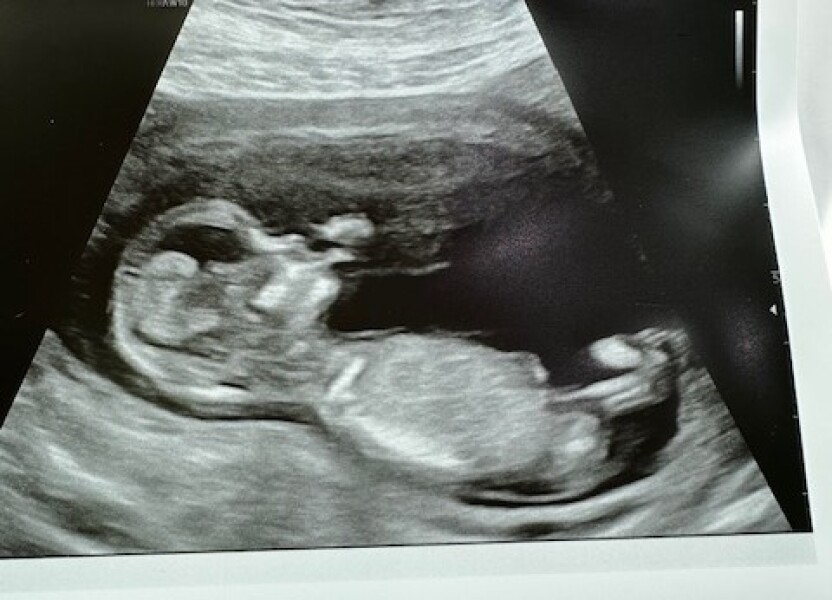 12 Week Scan