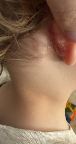 Cracked flaky skin behind my two year old's ears