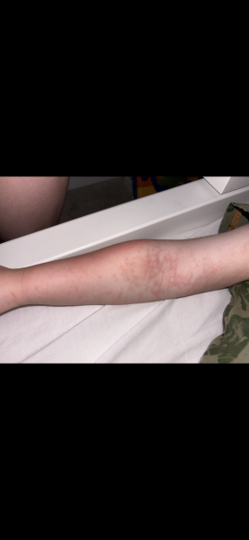 parvovirus