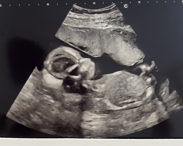 20-week scan baby kept moving, any guesses on baby's sex?