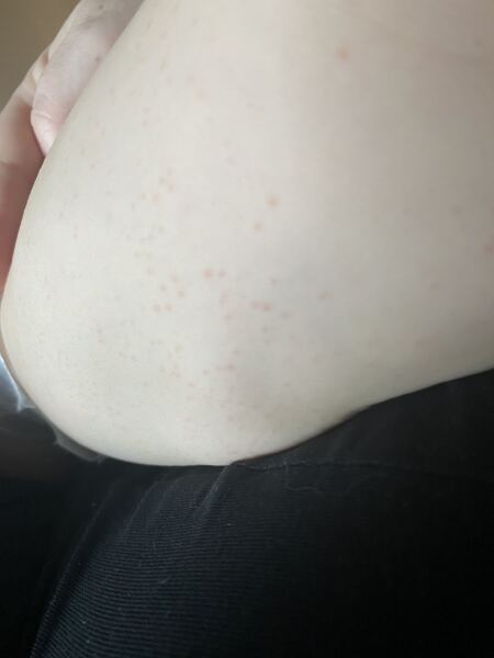 Rash on infant