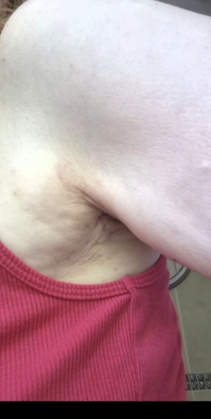 Extremely worried about this boob dimple