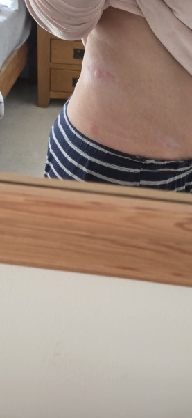 Could recurring hives before my period be linked to progesterone?