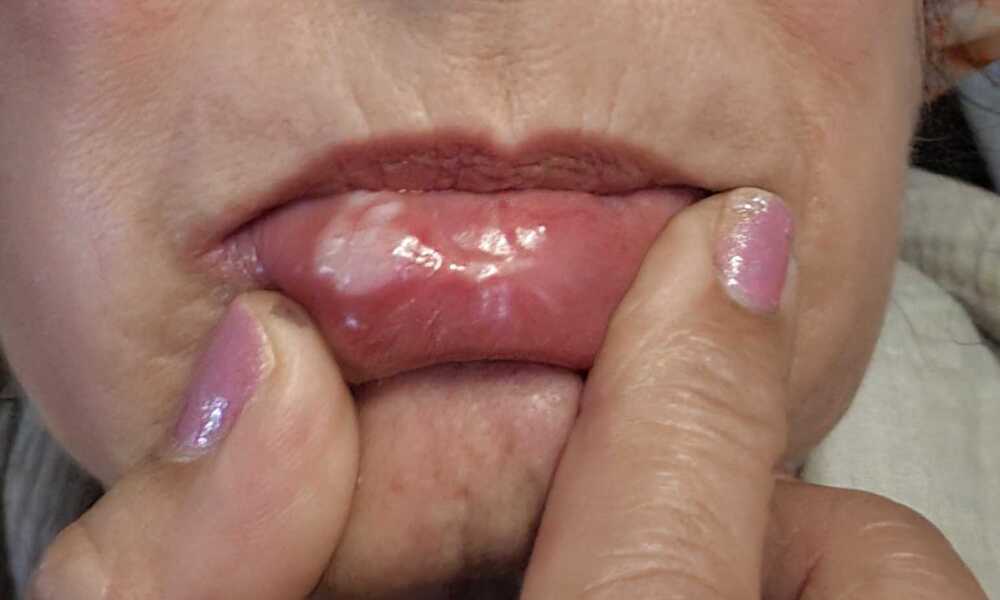 Blister after dentist