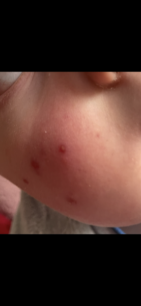Toddler acne or something else? Spots for over a year