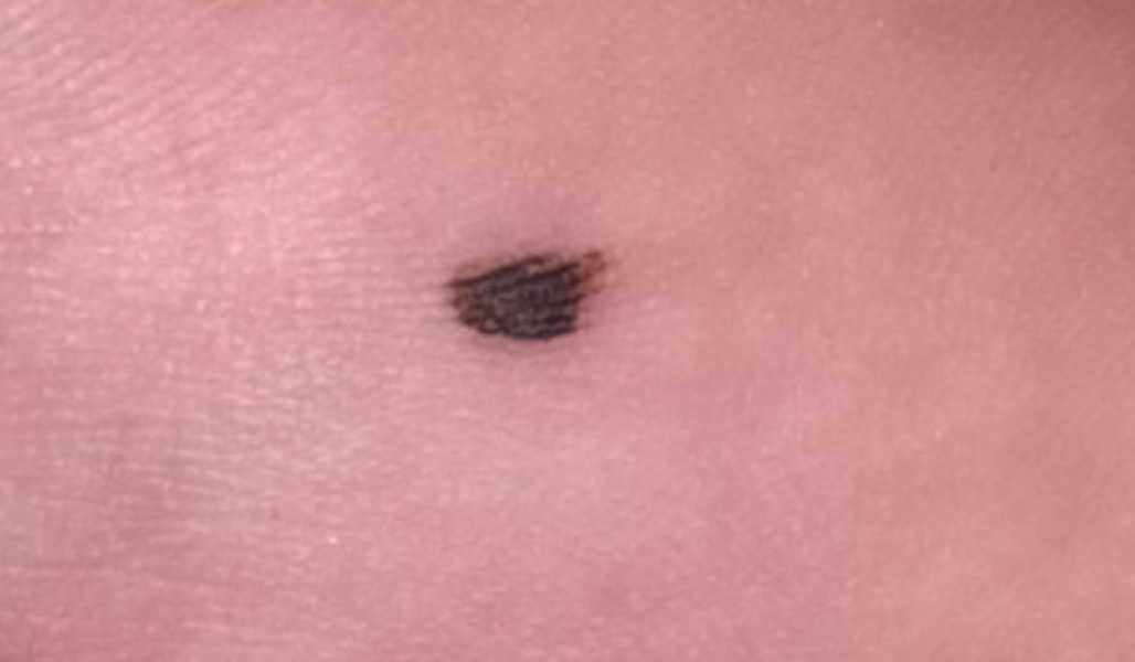 Black mole on side of foot