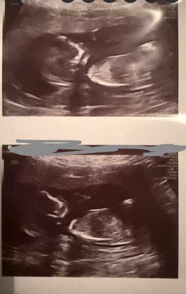 13 weeks 5 days scan, any nub theory guesses?