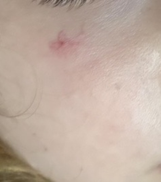 Will my four year olds spider naevus go?
