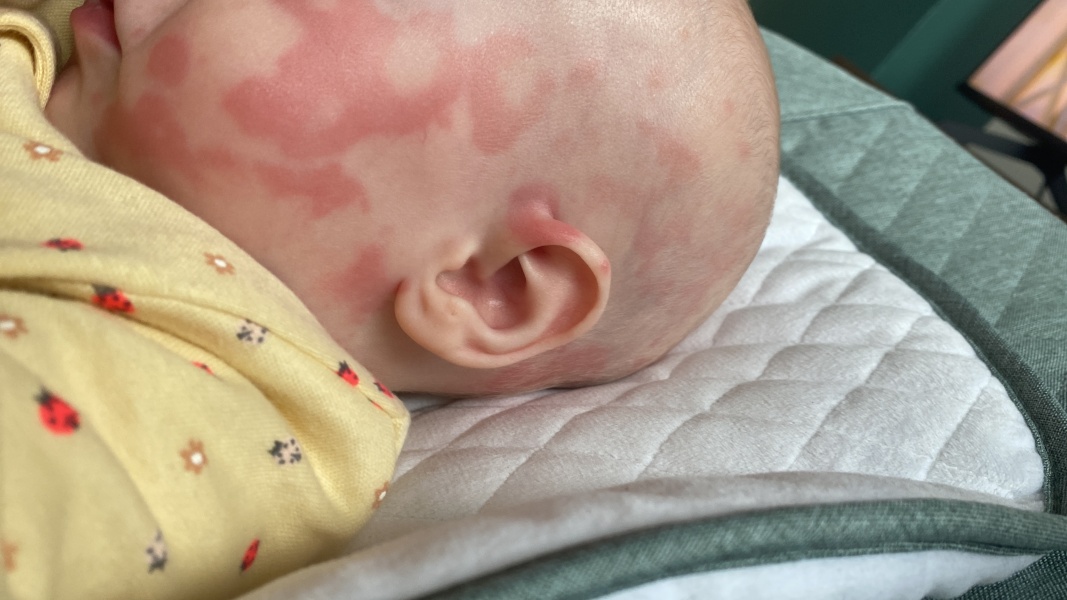 AIBU to worry about rash spreading after 12 week jabs?