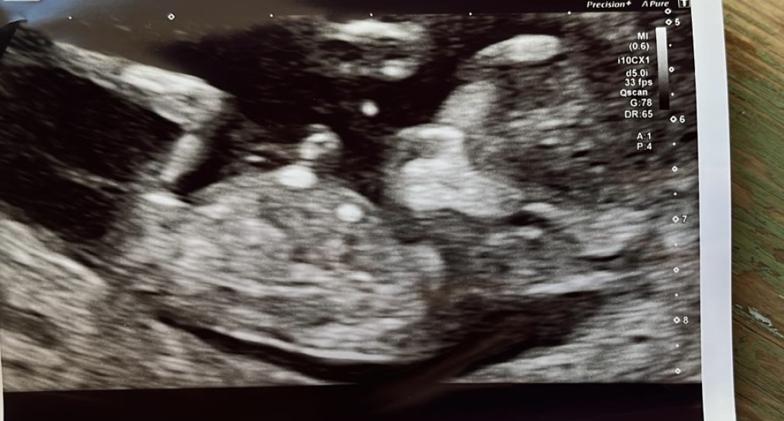 20-week scan baby kept moving, any guesses on baby's sex?