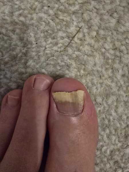 Line on big toe.