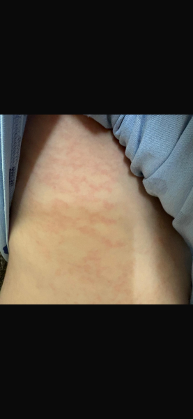 parvovirus