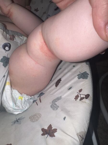 10 month old with a really bad rash! Any idea what it looks like/ could be and desperate for some home remedies.