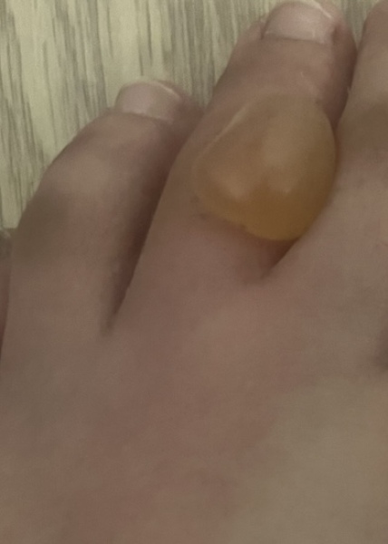 TW gross pic- any advice for large bubble blister on toe?!