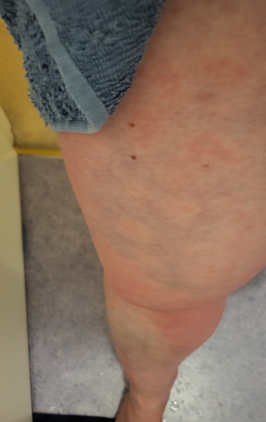 Strange blue mottled skin marks on legs