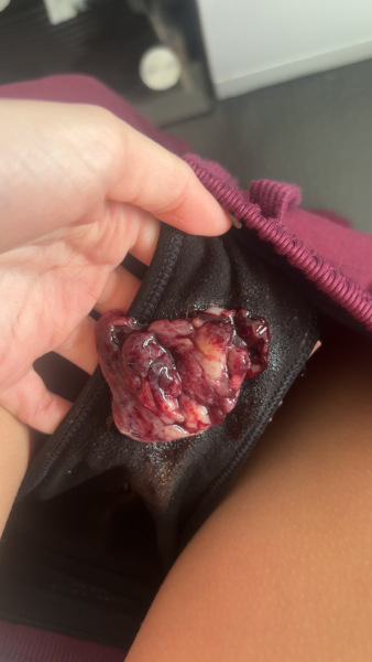 could this be a miscarriage after weeks of light bleeding?