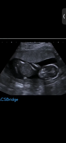 Still nauseous at 18 weeks and wondering about nub theory