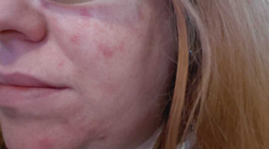Is this rosacea- what helps?