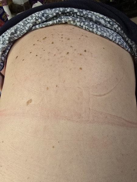 Could these be seborrhoeic keratoses or flat warts on my back?