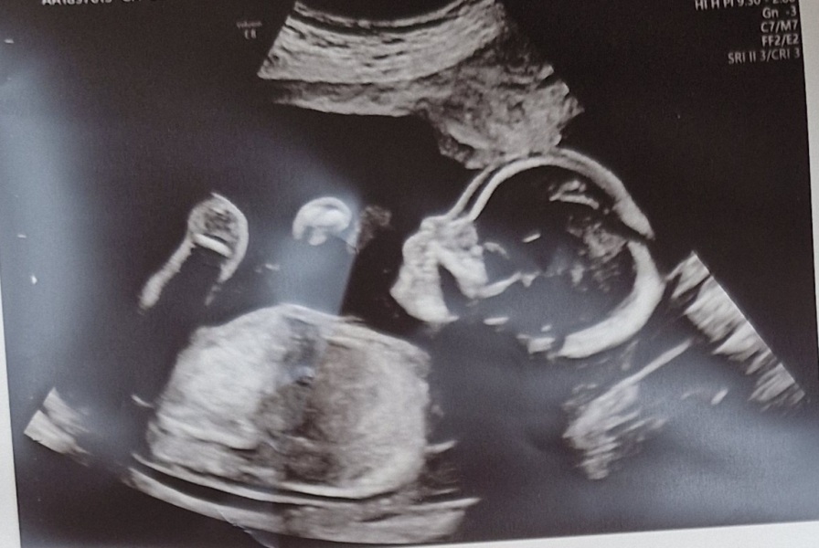 20-week scan guesses before we find out after the birth