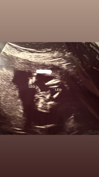 Early Gender Scan