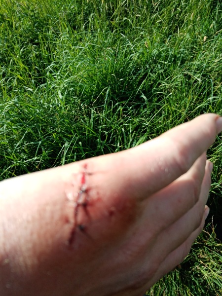 26 Hours For A Dressing To Be Removed Over Stitches?