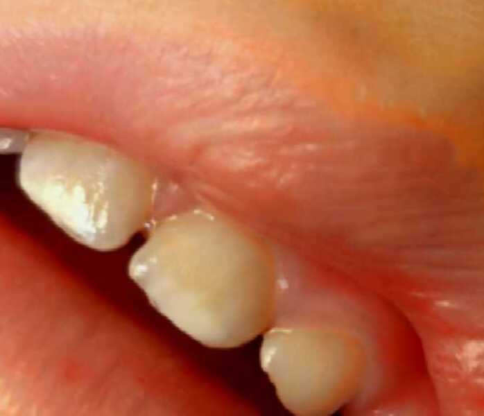 Discoloured teeth DC (3)