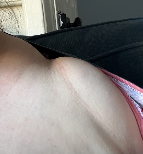 Breast reduction - why is it so difficult to get on the NHS?