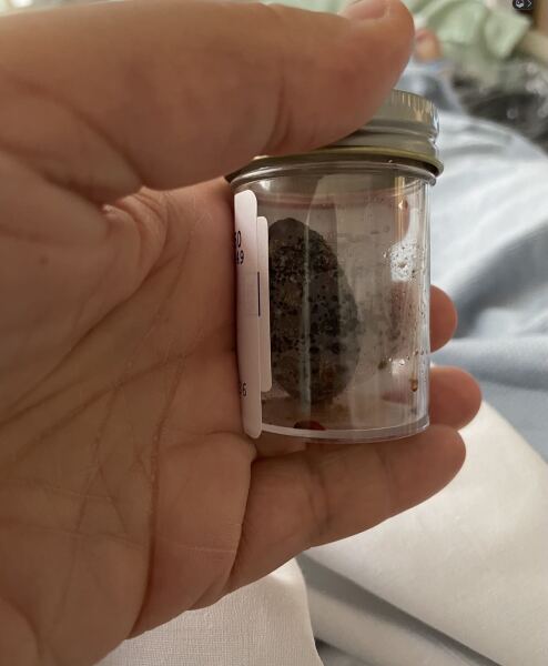 Gallstones help!