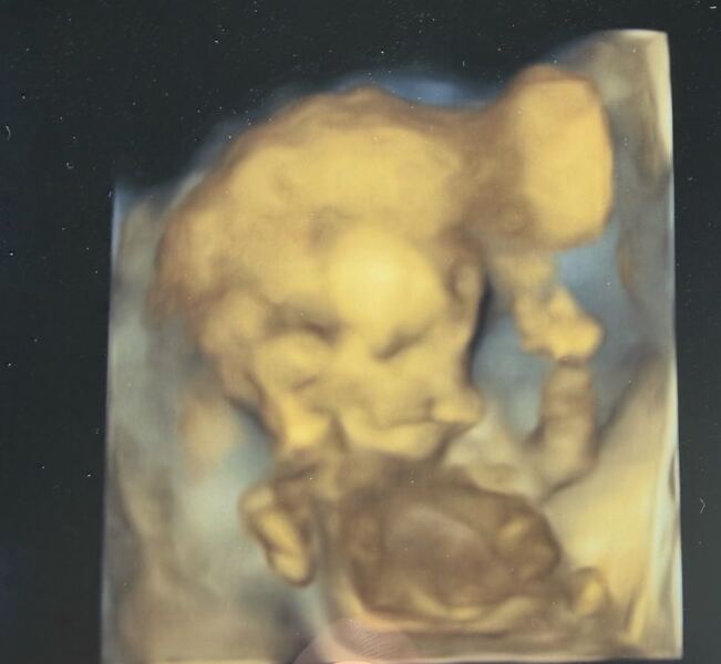 Cleft lip