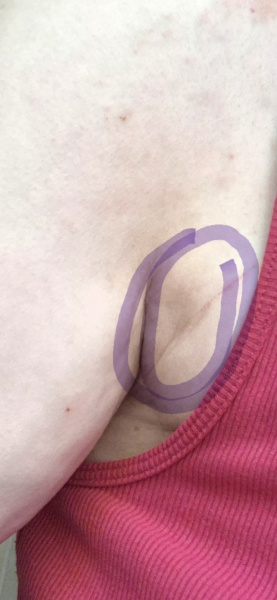 Extremely worried about this boob dimple