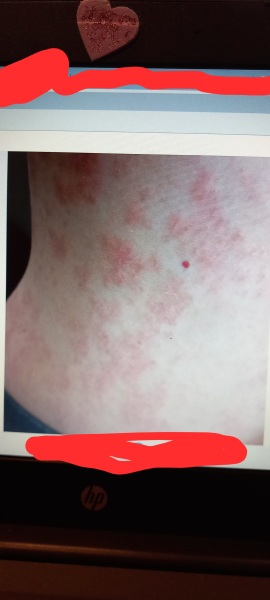 Rash driving me utterly mad - any ideas what it might be as I await referral to dermatology??