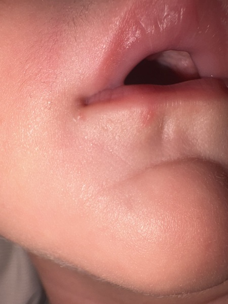 Do these spots look like a cold sore in a child?