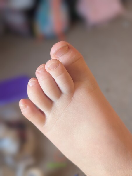 Wonky toed toddler